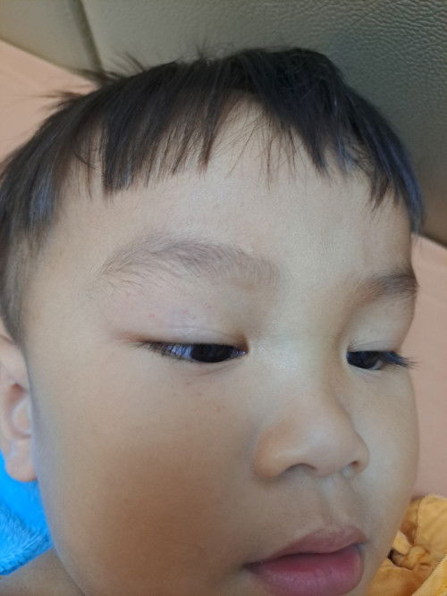 ผื่นจุดแดงขึ้นหน้าลูกใช้อะไรทาคะ