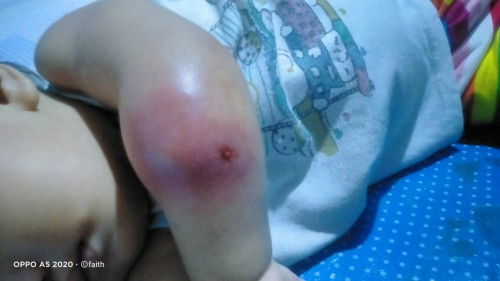 Ask lang po about sa sugat