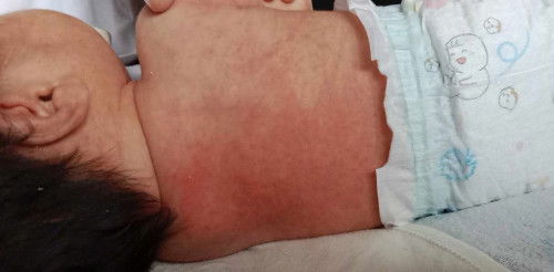 อยากทราบว่ามีผื่นขึ้นที่หัวและหลังนี้เกิดจากอะไรคะ อันตรายมั้ยคะ