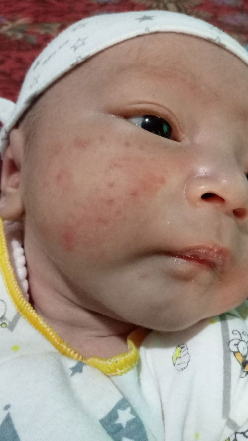 Minta saran bun bayi 16 hari bintik merah diwajah