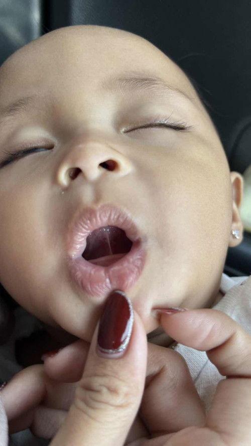 Lip tie dan tongue tie