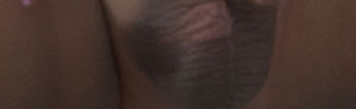 Bentol merah di buah zakar bayi 6 bulan