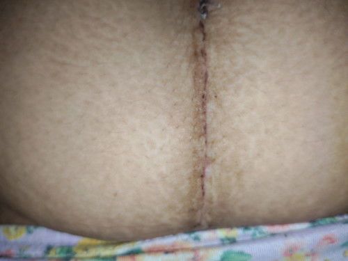 Sino same nakaranas ng ganito ? Sign ba to nabubuka yung tahi ? Kakapanganak ko pa kang nong aug. 10