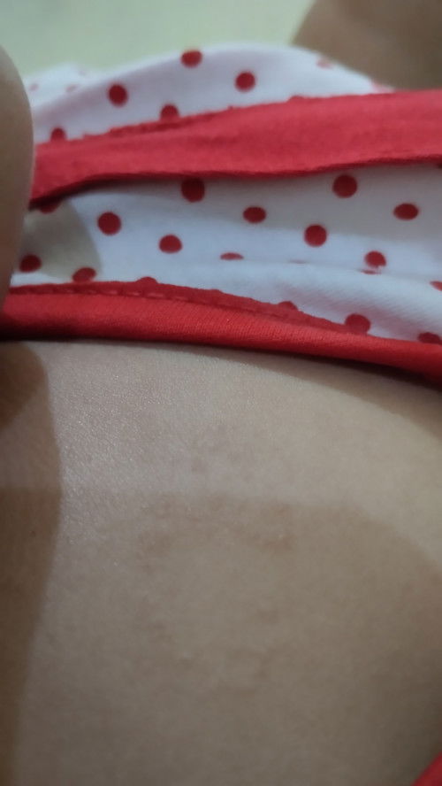 ringworm atau bukan ya bund