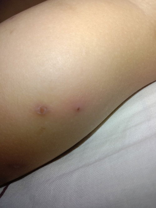 kagat po ba ng ipis o hindi?