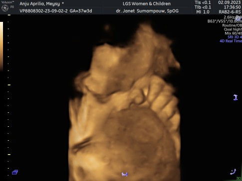 Plasenta menutupi wajah bayi