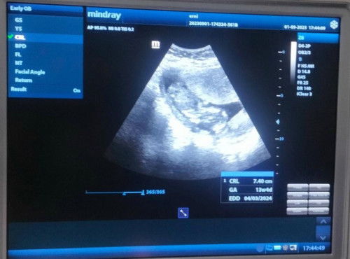 Wajar ga sih bun udah usg 13w4hri ini poto usg nya wajar ga ya bentuknya seperti itu???