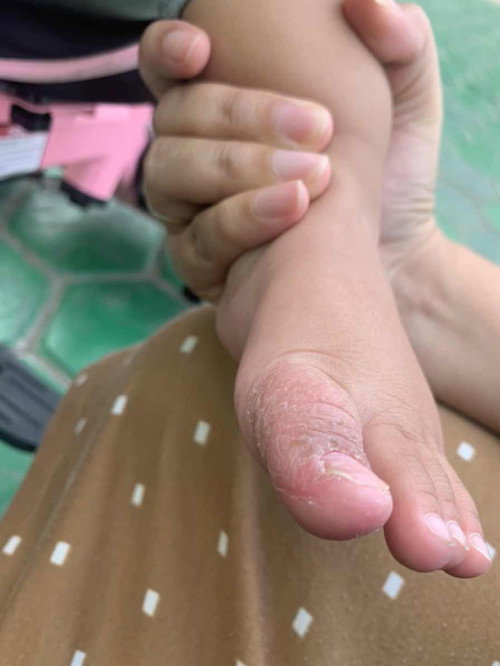 Kulit kering di kaki bayi