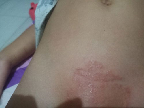 Bintik bintik merah dan gatal