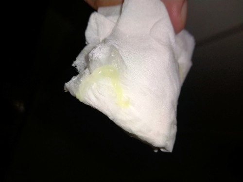 Mucus plug