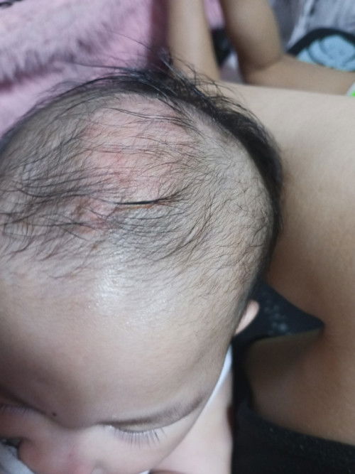 Namumula sa may bunbunan ni baby