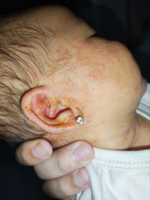 Kulit telinga bayi 1 bulan berair kuning