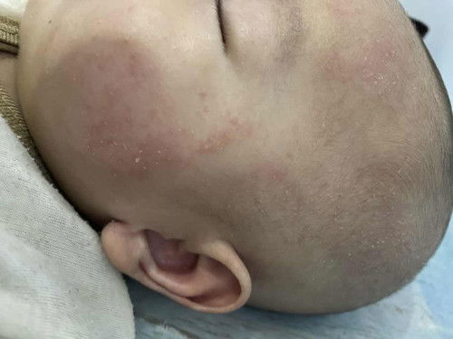 Merah merah dimuka bayi 3bulan