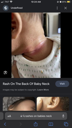 Baby neck rashes