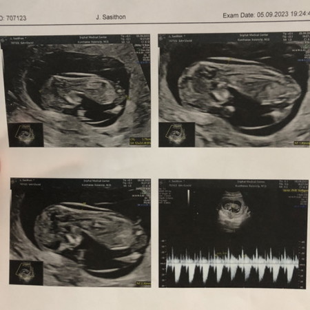 อัลตราซาวด์ครั้งแรก