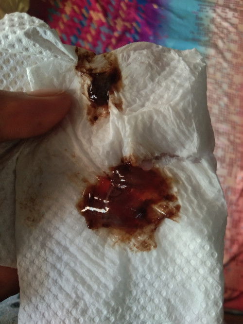 Normal lang po ba na may lumlabas na dugo po skin at ganito po FTM poDi namn sumskit puson q. 39wks