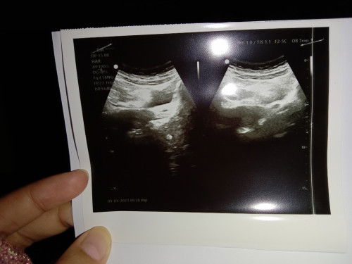 Disuruh kuret usia 8week