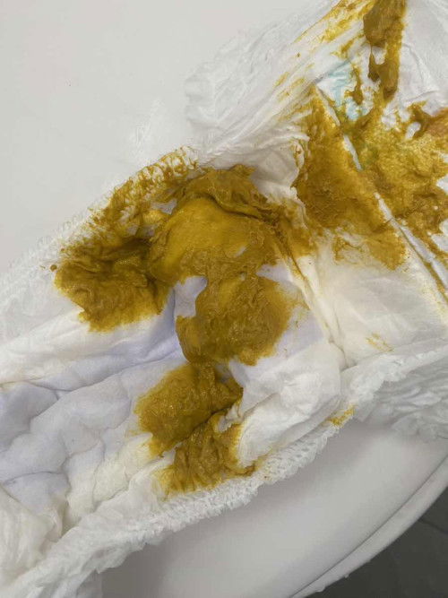 Hi nk tanya mommy najis ni normal ke baru nak ajar ank susu SF tapi still lagi BF , bby saya 8month