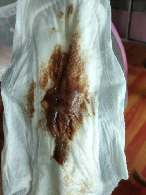 Mucus plug
