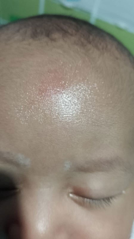 Jidat terbentur gigi ibu saat di gendong