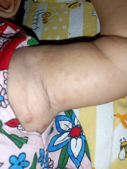Obat atau salep yang tepat untuk gatal-gatal anak umur 8bulan