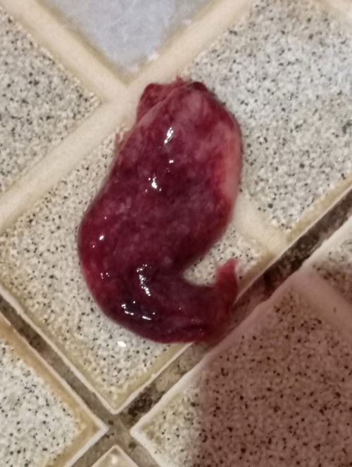 Gumpalan haid bukan???