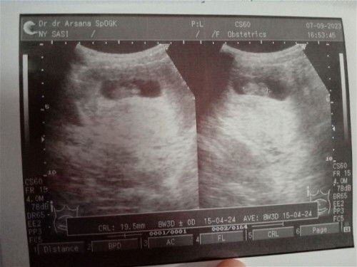 Usg 10 week.. Hamil yang ke-2.. Yang pertama keguguran&kuret