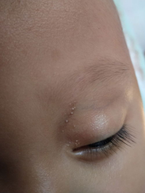 Bintik putih dikelopak mata