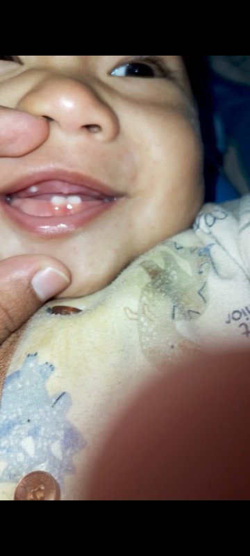 Tumbuh gigi bukan gigi yg tengah