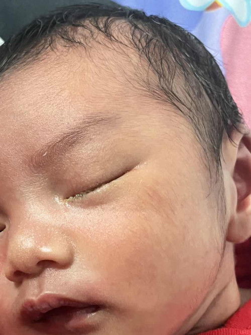 แบบนี้ตาติดเชื้อ หรือ ท่อน้ำตาอุดตันคะแม่ๆ