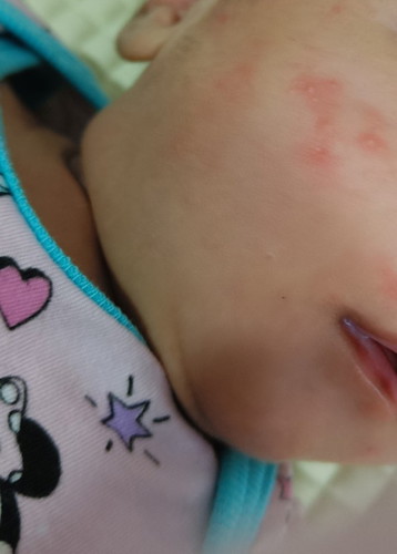 Ruam di muka baby
