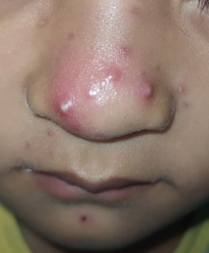 Bintik dihidung