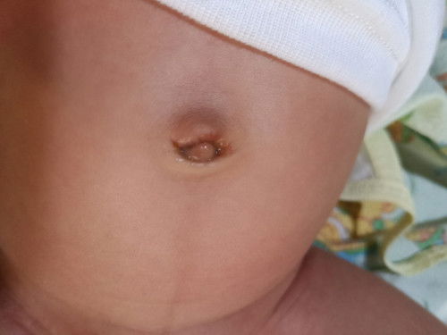 Pusar bayi belum kering sudah 1 bulan