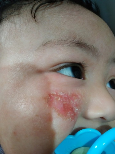 Eczema ni baby na pabalik balik