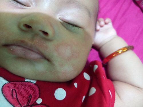 Gatal di wajah bayi usia 3 bulan 15 hari