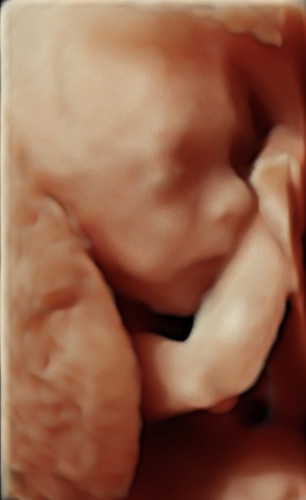 Gastroschisis หรือ ความผิดปกติแต่กำเนิดของผนังหน้าท้องในทารกแรกคลอดที่ปิดไม่สนิท