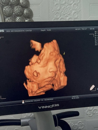 3D/4D Ultrasound