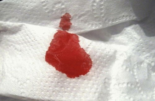 Dấu hiệu gần chuyển dạ ?