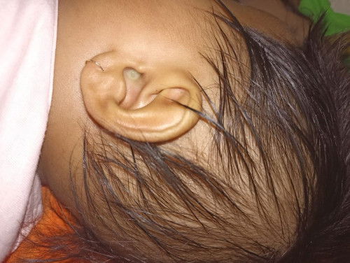 Telinga seperti ada ingus