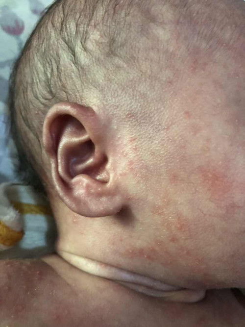 Badan bayi merah merah