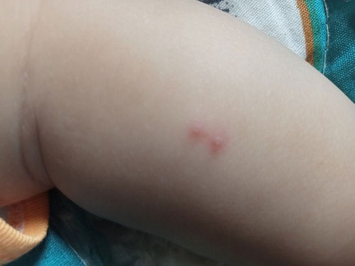 คือตุ่มอะไร