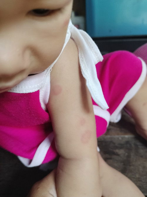 ลูกๆบ้านไหนเป็นผื่นแบบนี้บ้างคะ