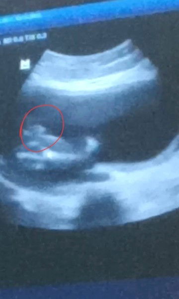 INI HASIL USG CEWEK ATAU COWOK ?