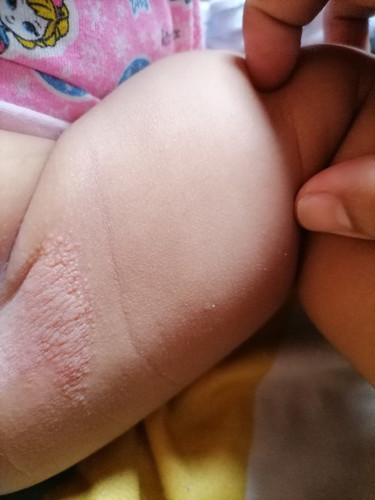 Diaper rash?