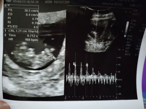 Alhamdulillah habis USG kandungan sekitar 10 minggu