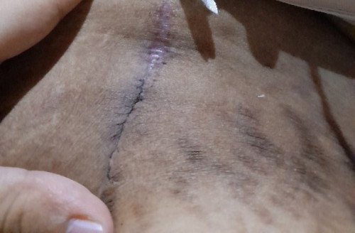 CS mom concern about cesarean wound