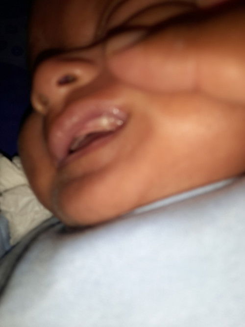 Putih di gusi bayi 2 bulan