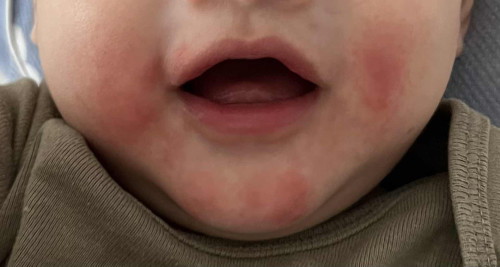 Baby face rash