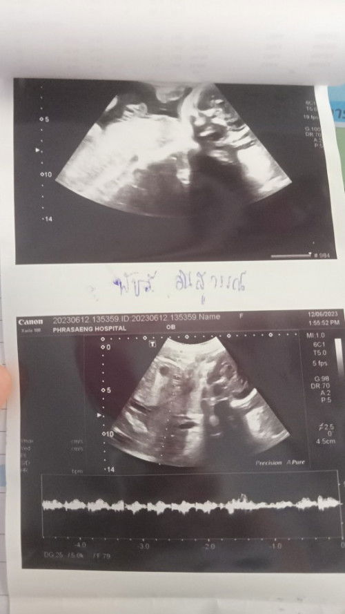 สอบถามเพศหน่อยคะท้องแรก