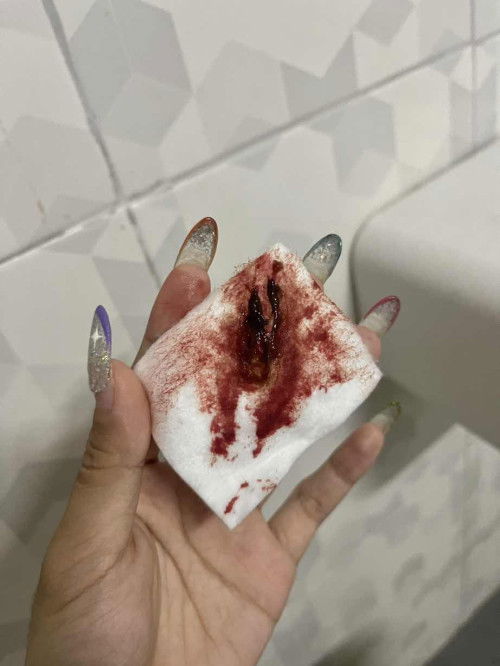 ปวดท้องน้อยเป็นๆหายๆ มีเลือดออก